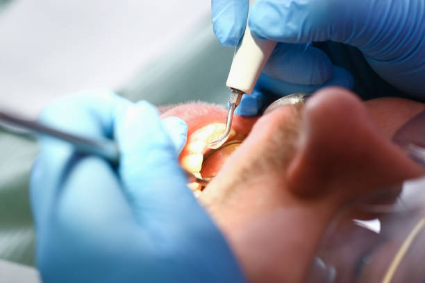 Best Emergency Dentist for Lost Fillings or Crowns in Eustis, FL